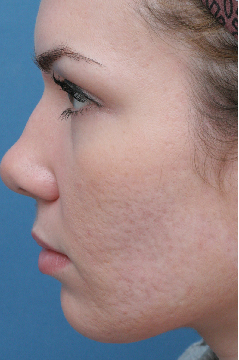 Close-up of a woman's face showing acne scars on her cheek.
