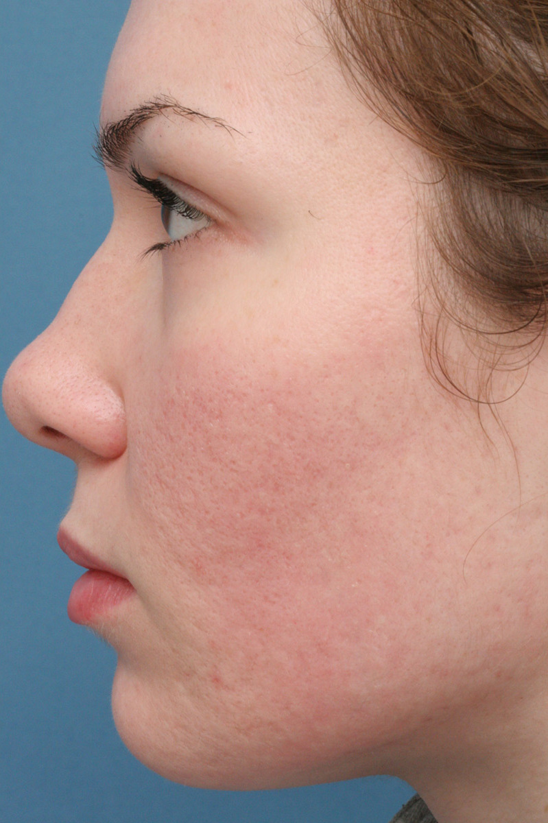 Close-up of a woman's face showing mild redness and skin texture.
