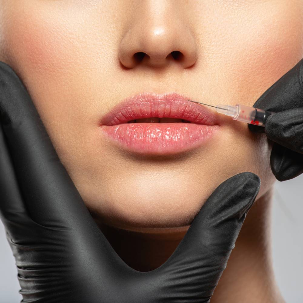 Close-up of a woman receiving lip filler injection treatment.