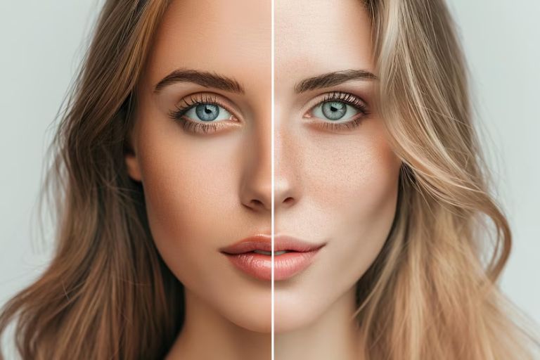 Masseter Botox: Before and After